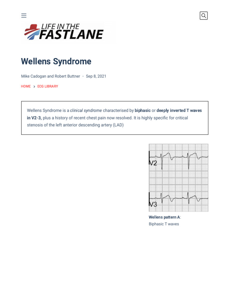 Wellens Syndrome - LITFL - ECG Library Eponym | PDF ...