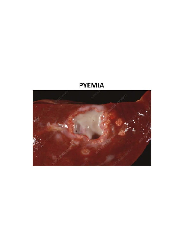 Pyemia | PDF