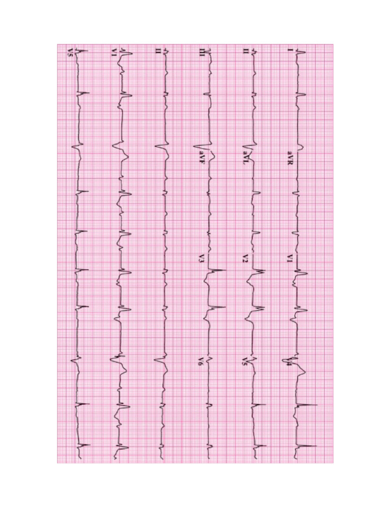 Electrocardiogramas Normales | PDF