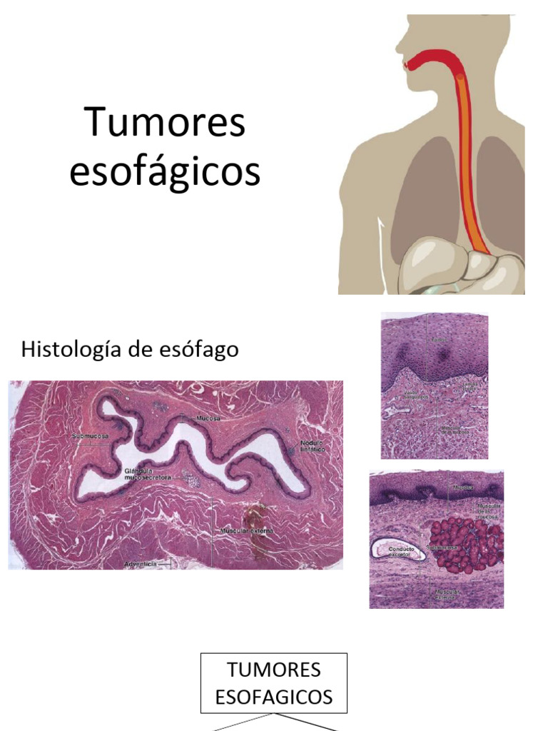 Tumores esofágicos: tipos y diagnóstico | PDF | Neoplasias | Cáncer de ...