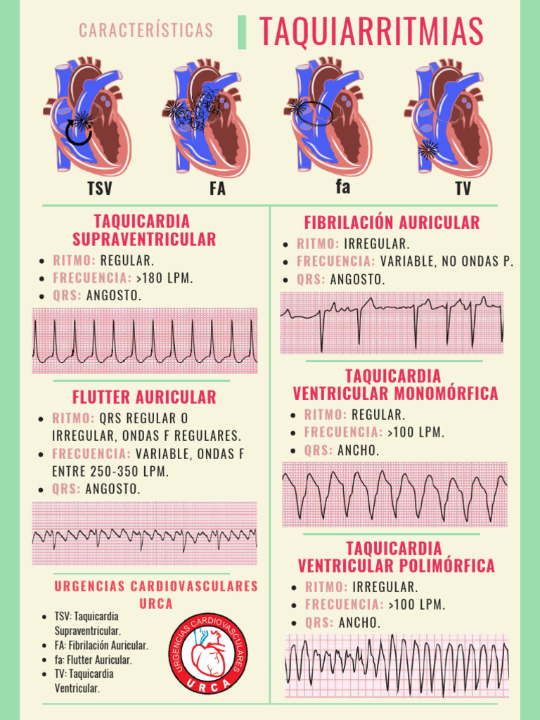 Taquicardias: Tipos y Características | PDF