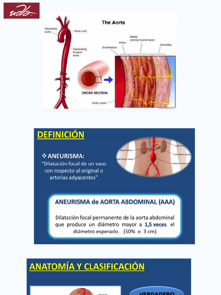 Aneurisma de La Aorta | PDF