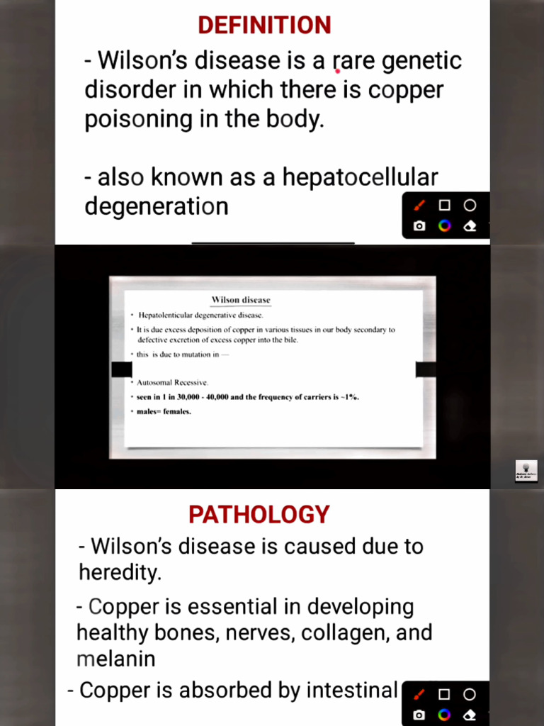 Wilson Disease | PDF