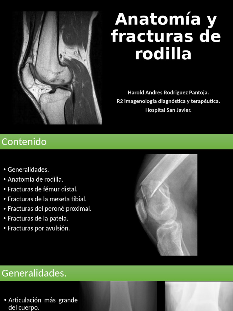 Anatomía y Fracturas de Rodilla | PDF | Rodilla | Sistema ...