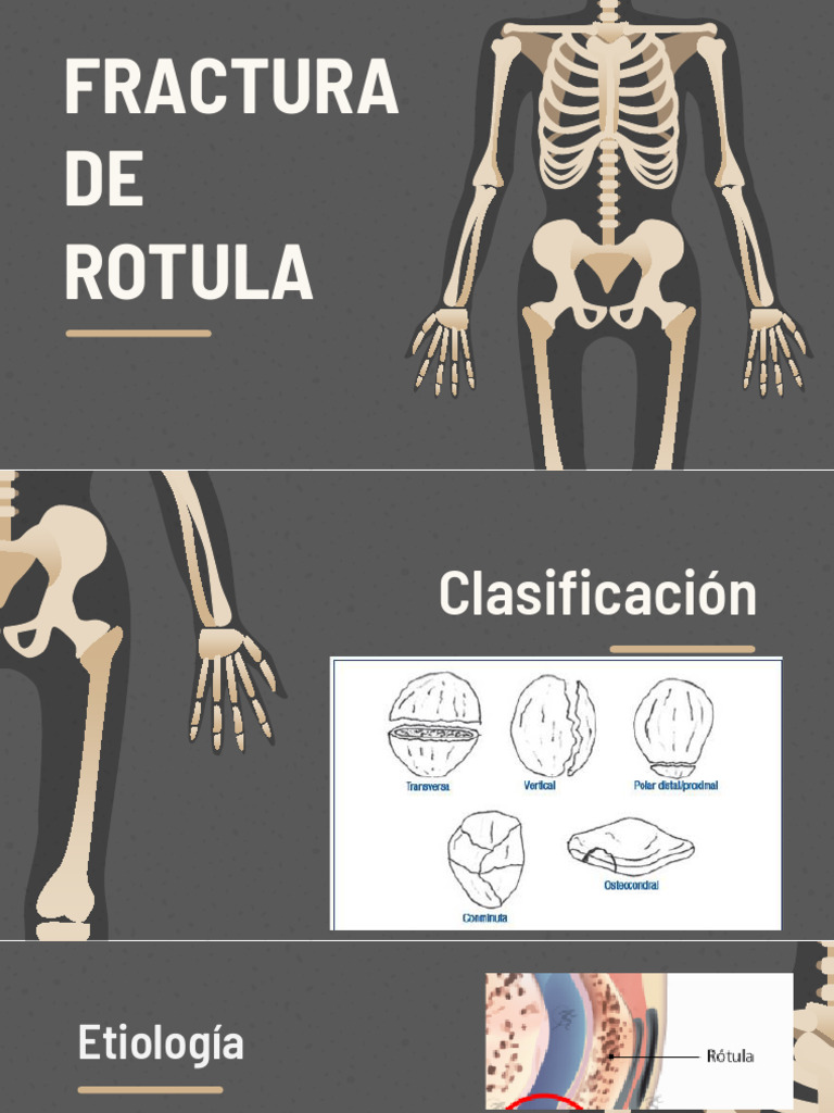 Fractura de Rotula 2 | PDF | Rodilla | Enfermedades y trastornos