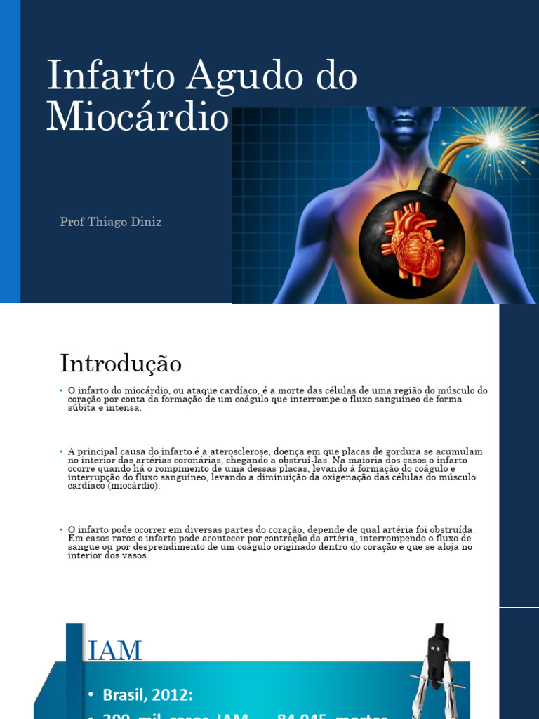 Infarto Agudo do Miocárdio: Causas e Cuidados | PDF | Infarto do ...
