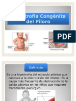 Hipertrofia Congénita Del Píloro