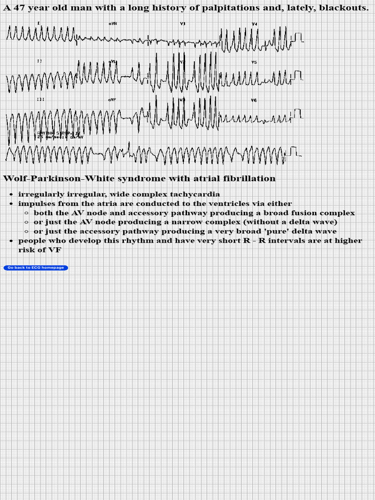 WPW Syndrome With Atrial Fibrillation | PDF