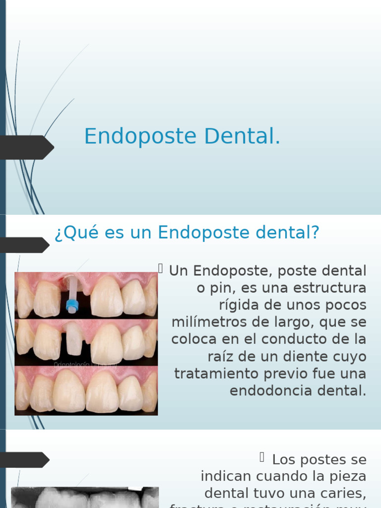 Funciones y Ventajas del Endoposte Dental | PDF | Diente | Odontología