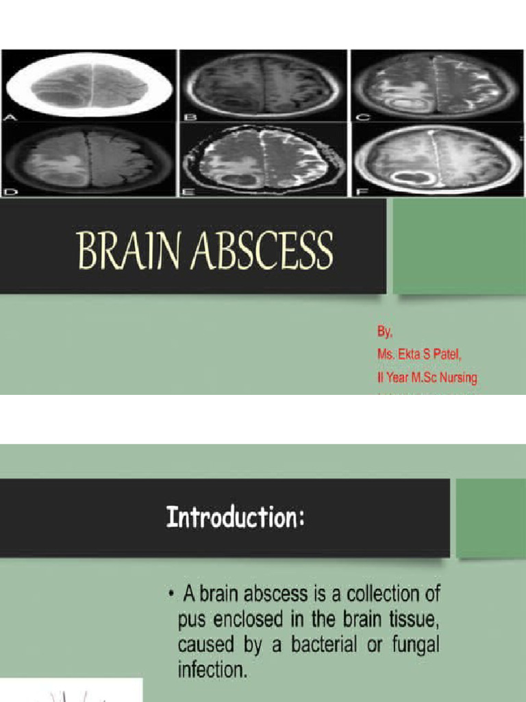 Brain Abscess | PDF