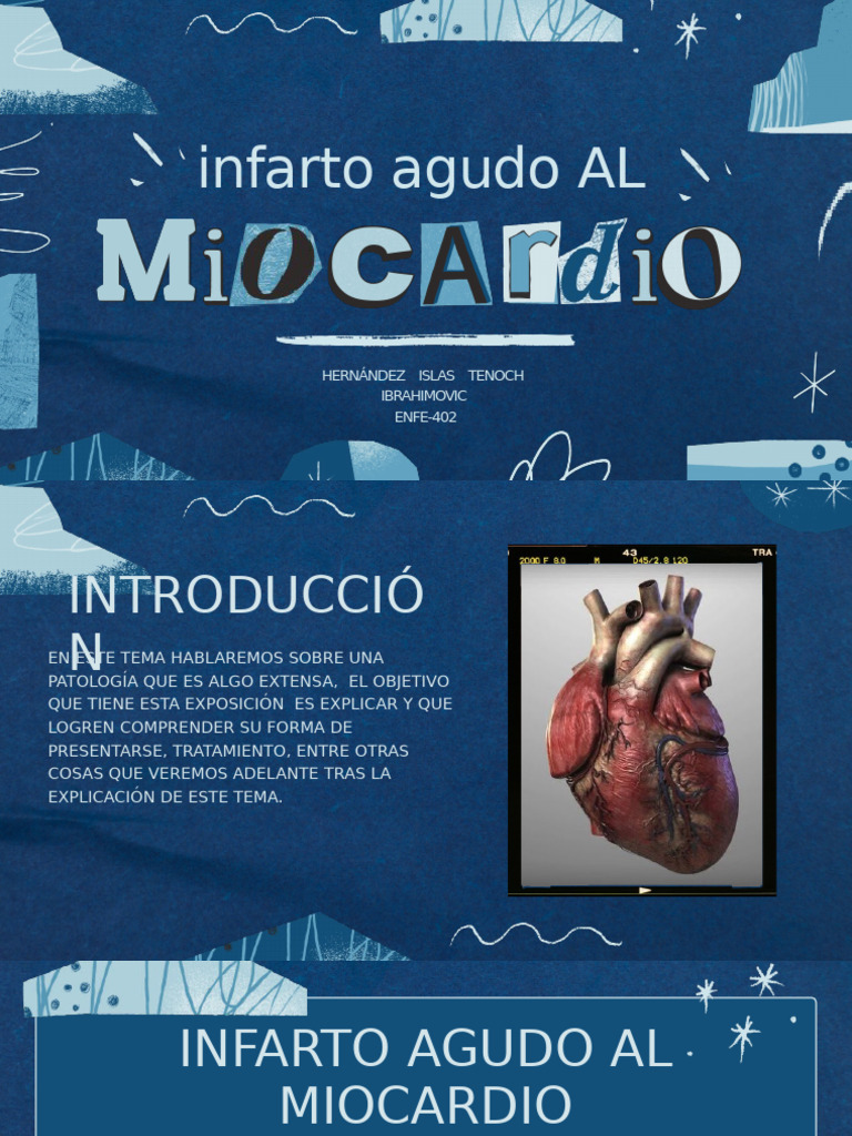 Infarto Agudo de Miocardio - 20240528 - 204514 - 0000 | PDF | Infarto ...