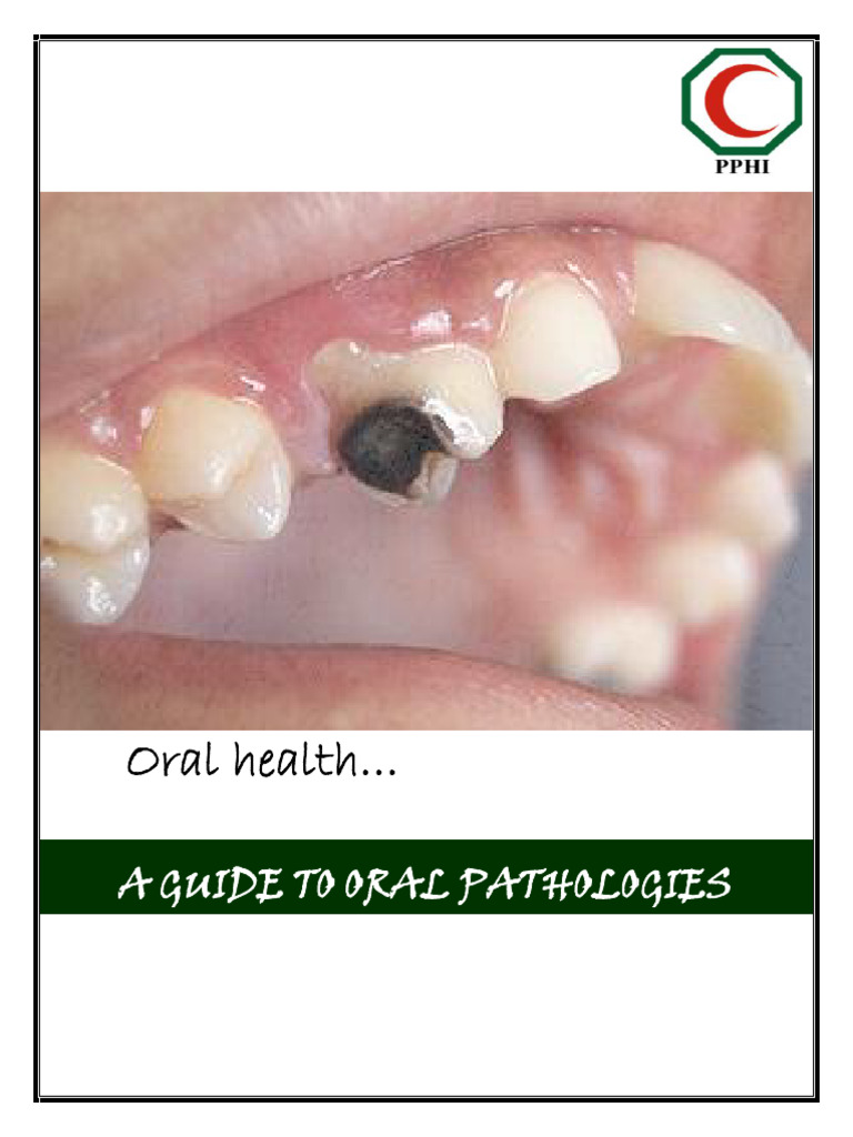 Dental Caries 1 | PDF | Periodontology | Human Tooth