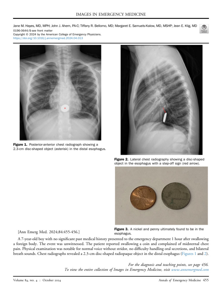 Child Who Swallowed a Foreign Body Ymem | PDF | Radiography | Diseases ...