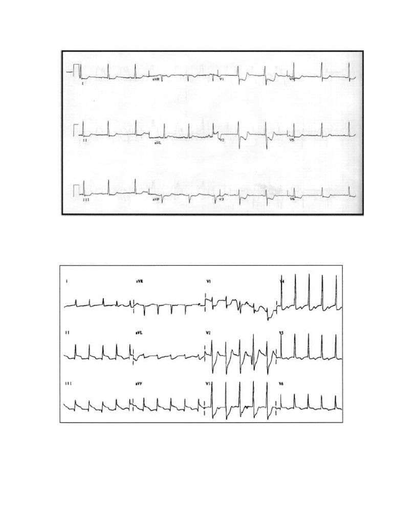 ECG | PDF