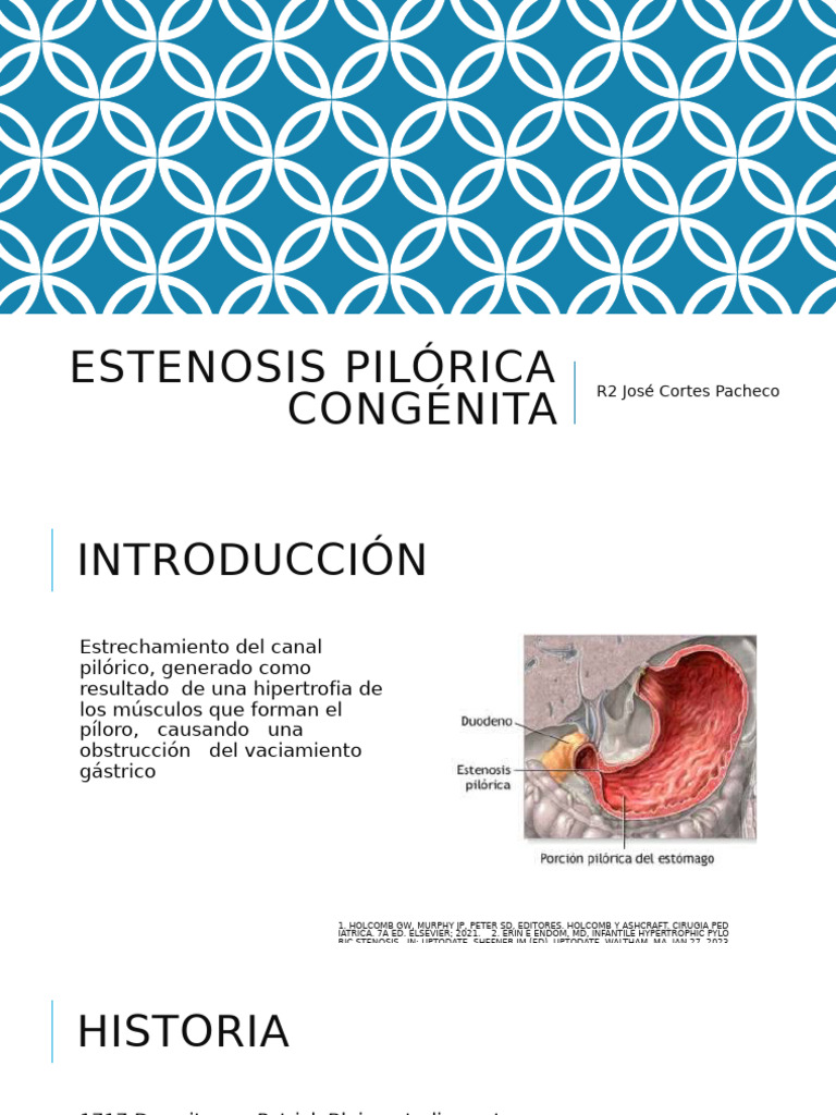 Signo de la cuerda en estenosis pilórica | PDF | Cirugía | Abdomen
