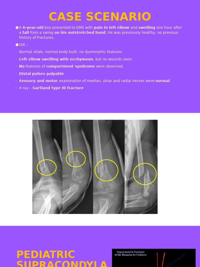 Supracondylar Humerus Fracture Overview | PDF | Elbow | Limbs (Anatomy)