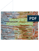 Causas de Las Lesiones Pulpares