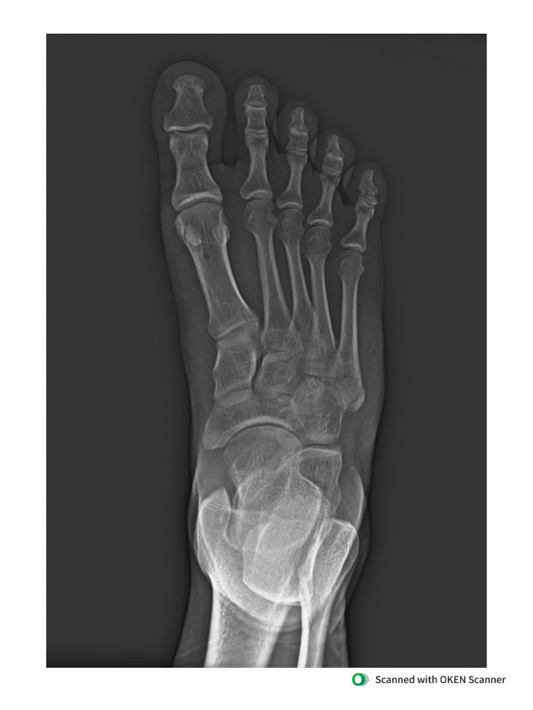 XRayof 5th Metatarsals Base Bone Fracture | PDF