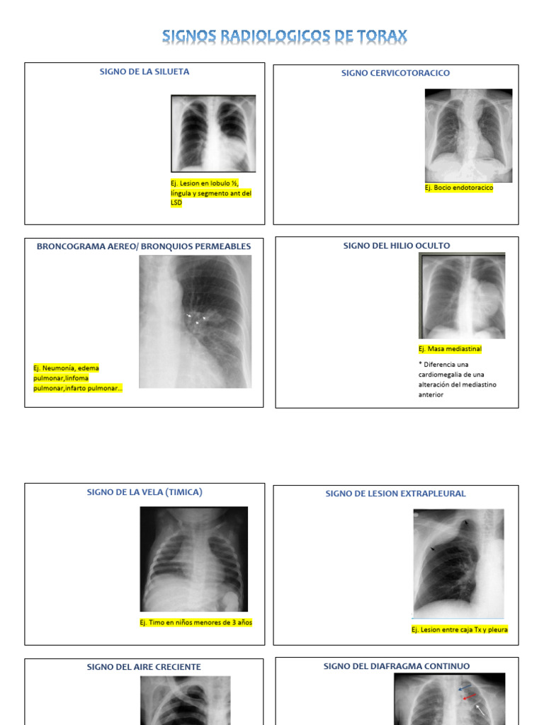 Signos Radiológicos en Lesiones Pulmonares | PDF | Pulmón | Medicina ...