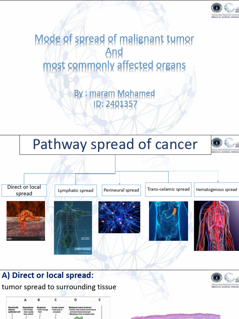 Cancer Metastasis Pathways Overview | PDF
