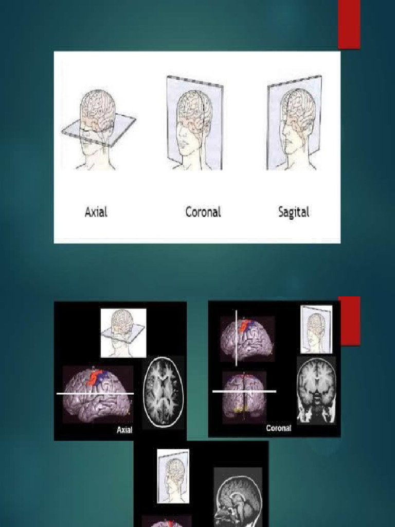 CT Brain | PDF