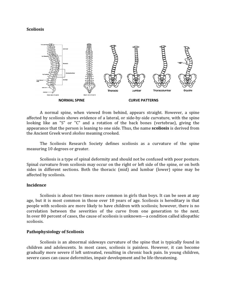 King Classification of Scoliosis | PDF | Scoliosis | Ct Scan