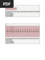 Memahami Normal Sinus Rhythm EKG | PDF