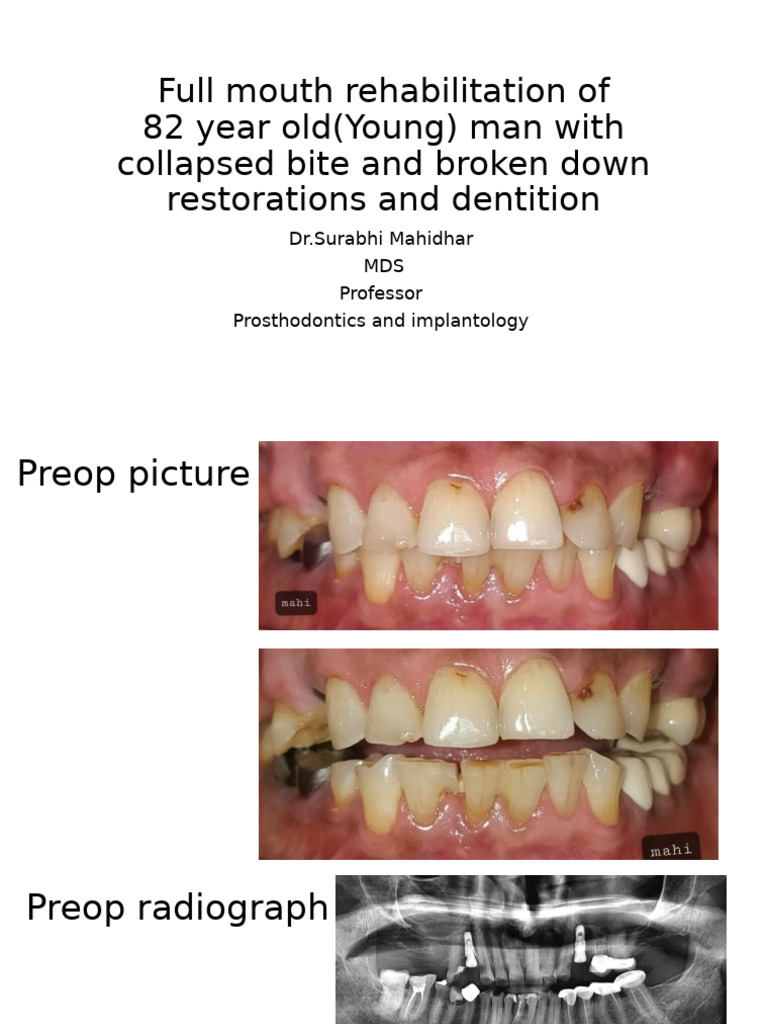 Full Mouth Rehabilitation for Elderly Patient | PDF
