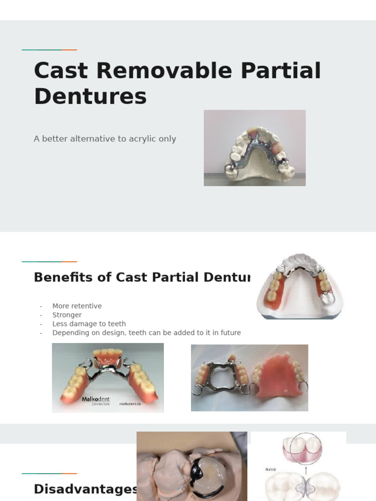 Cast Removable Partial Dentures | PDF
