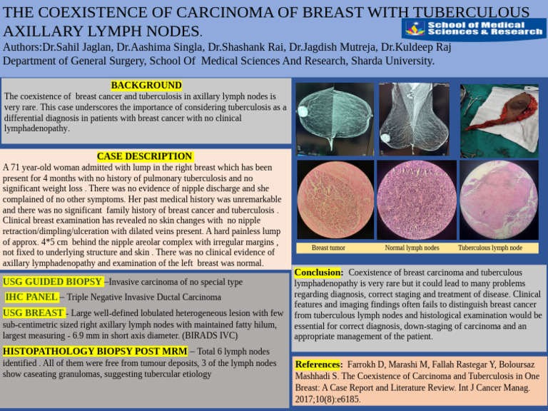 Sahil Poster Final | PDF | Breast Cancer | Clinical Medicine
