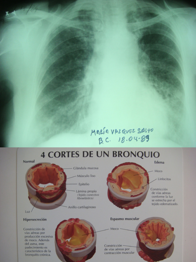 Bronquitis crónica | PDF