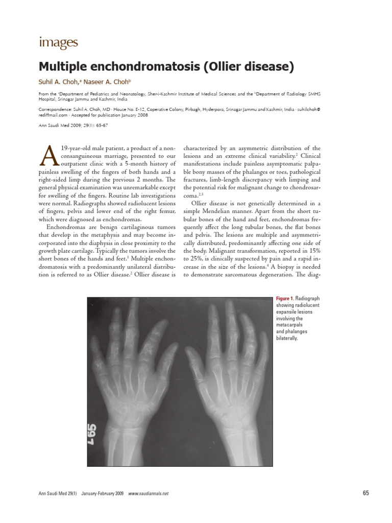 Ollier Disease: Clinical Insights | PDF | Medical Specialties ...