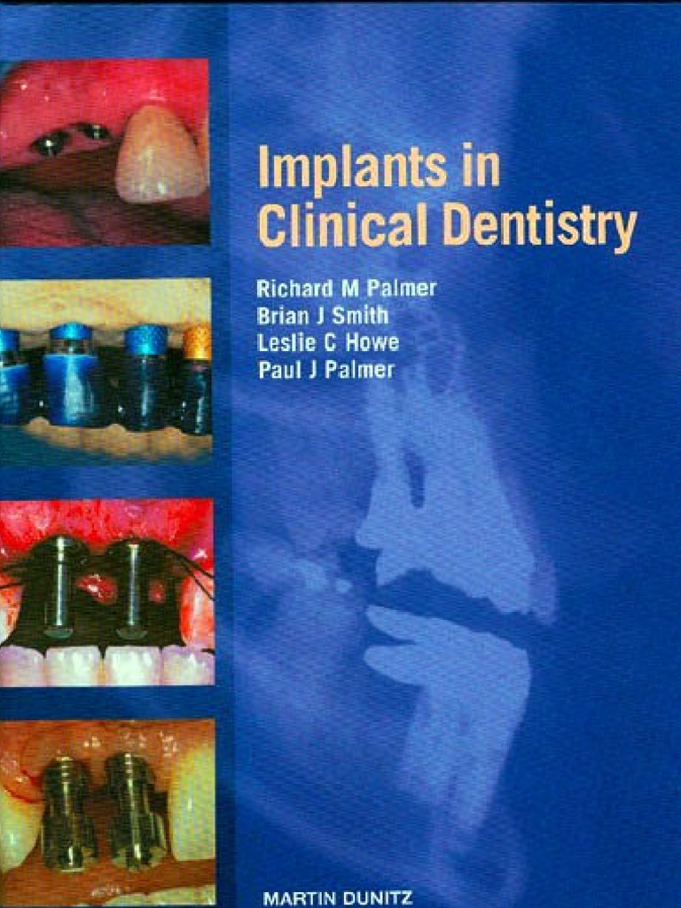 Implants in Clinical Dentistry 2002 Palmer PDF Dental Implant Bone