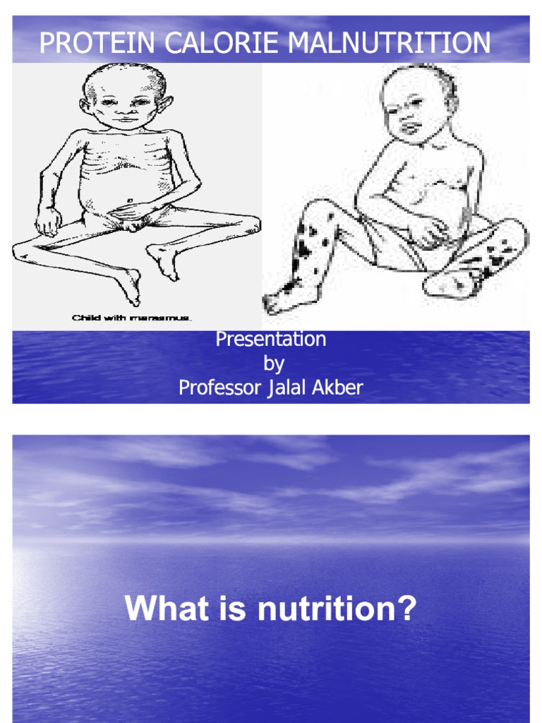 Protein Calorie Malnutrition PDF Malnutrition Medicine
