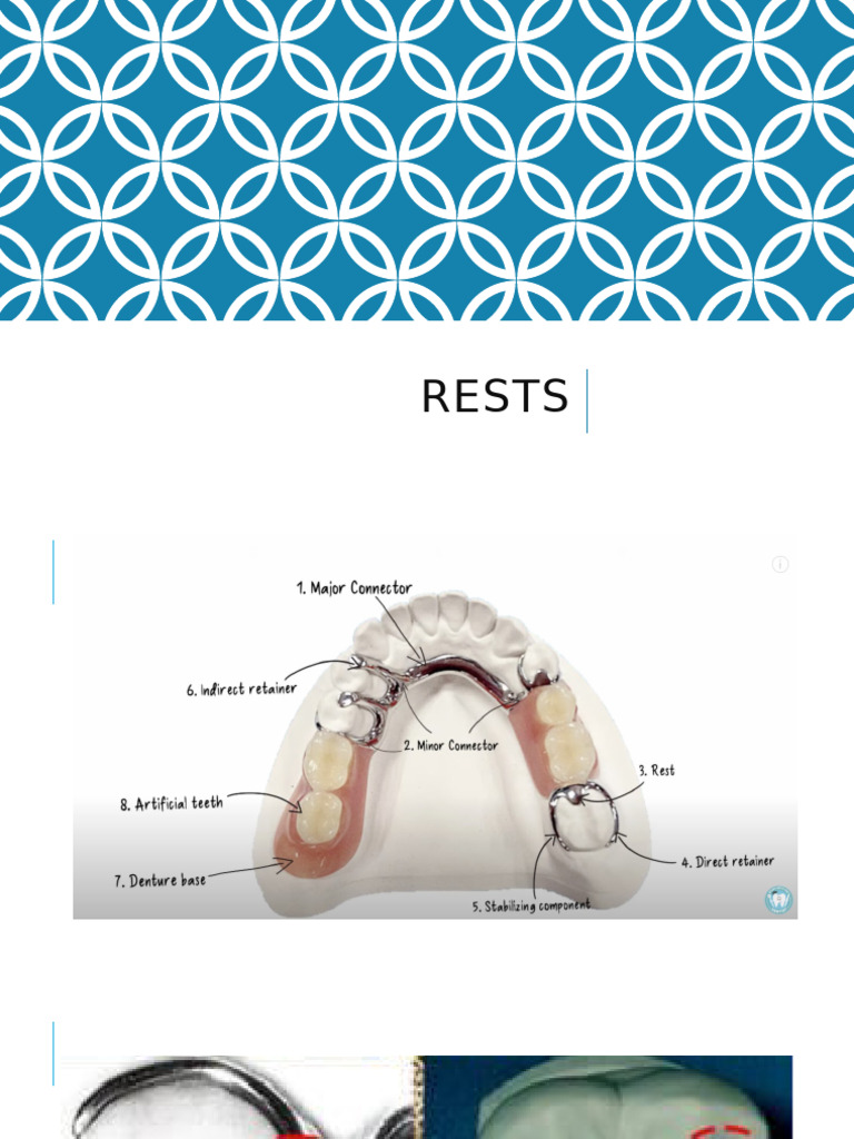 Understanding Rests in RPDs | PDF