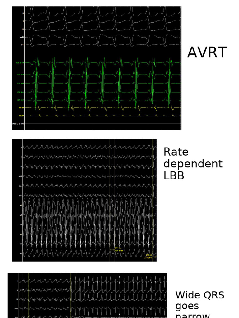 Avrt LBB | PDF