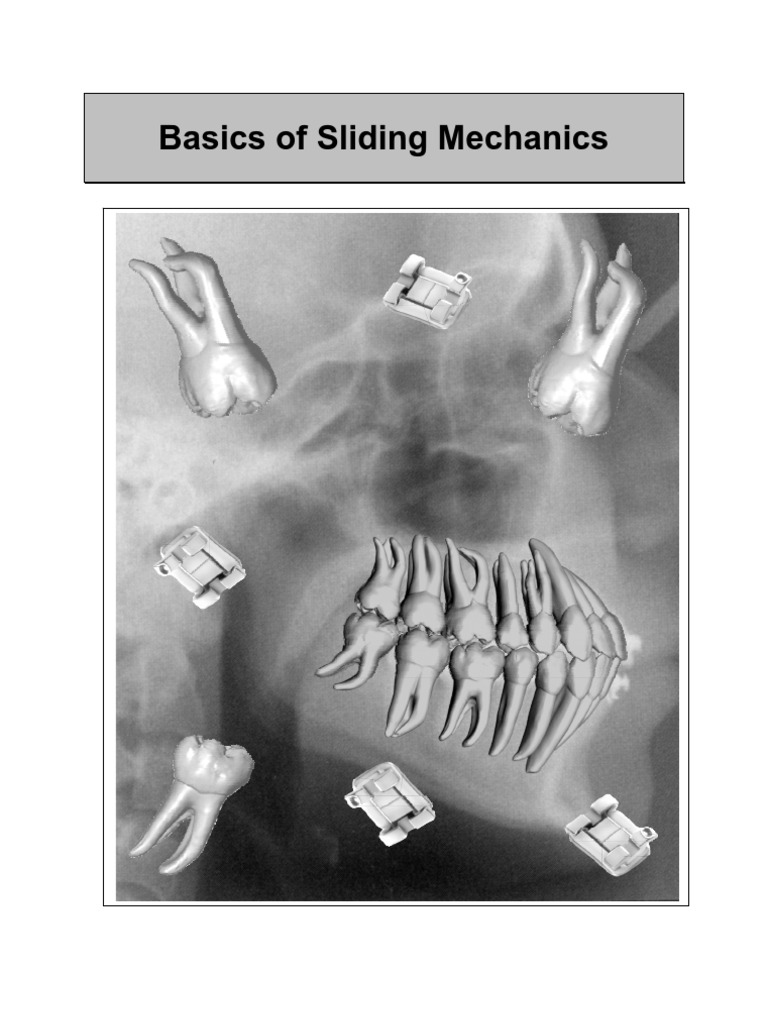 WichelhausThe Basics of Sliding Mechanics PDF Orthodontics