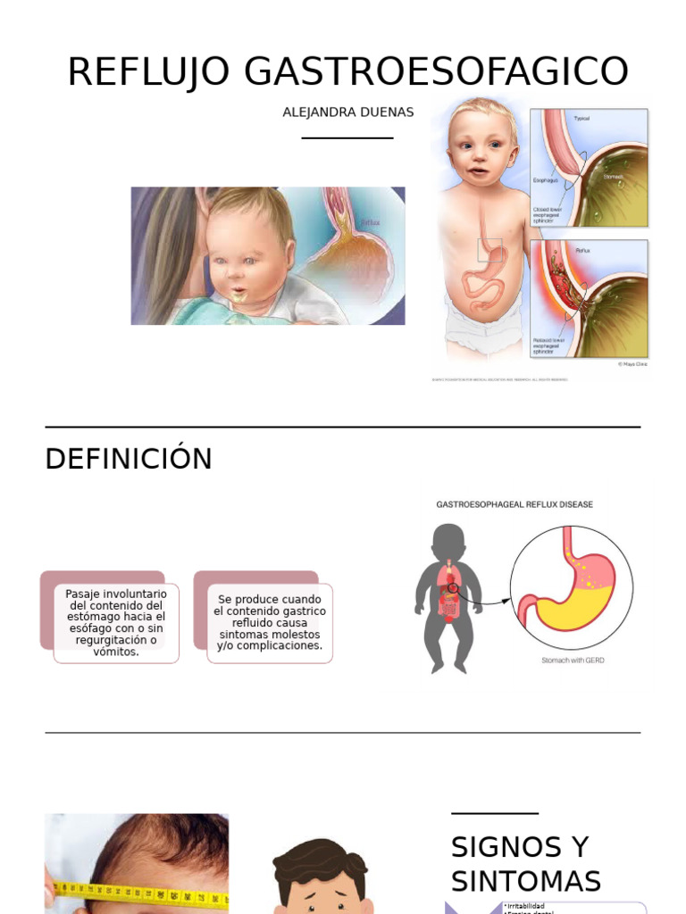 Reflujo Gastroesofagico Pediatria | PDF | La enfermedad por reflujo ...