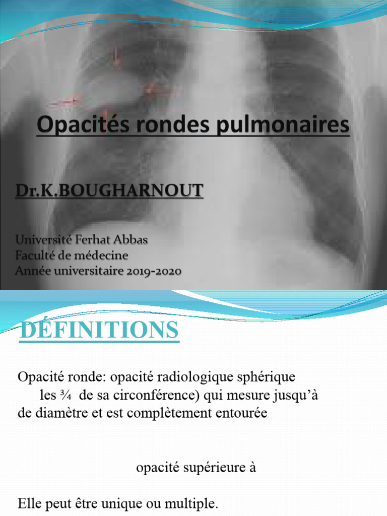 Opacités pulmonaires : diagnostic et étiologies | PDF | Cancer | Médecine