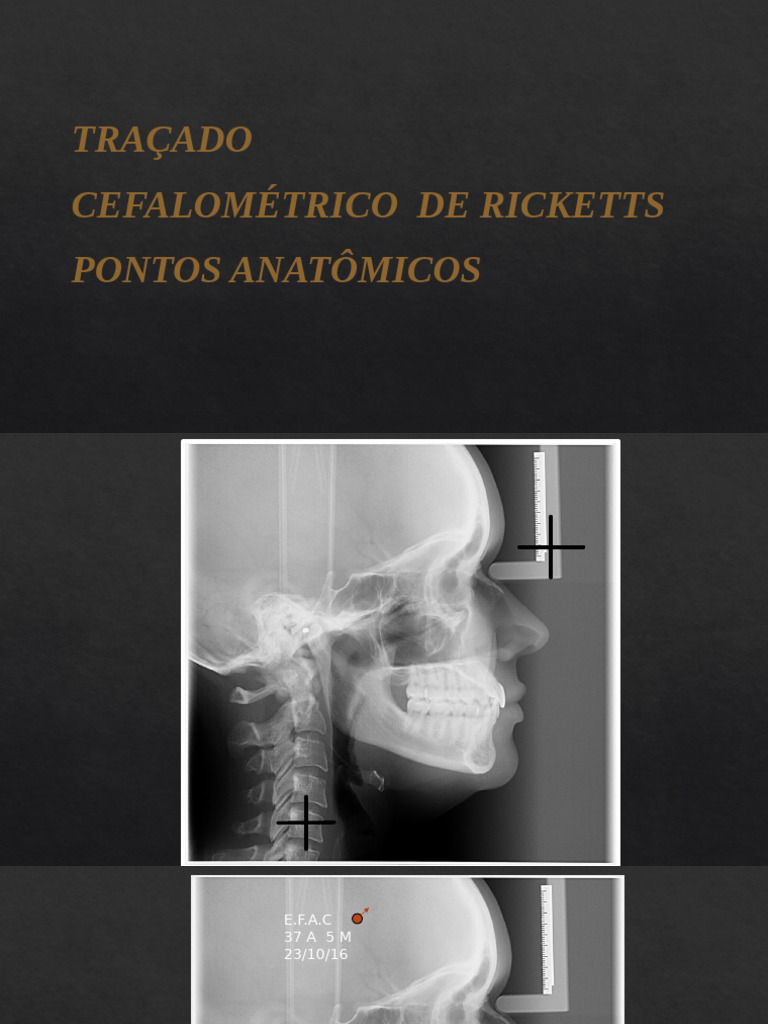 Análise Cefalométrica de Ricketts | PDF | Cabeça e pescoço humano ...