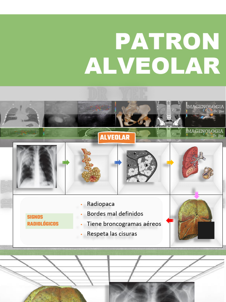 3a. Patron Alveolar Adicional | PDF | Pulmón | Imagenes medicas