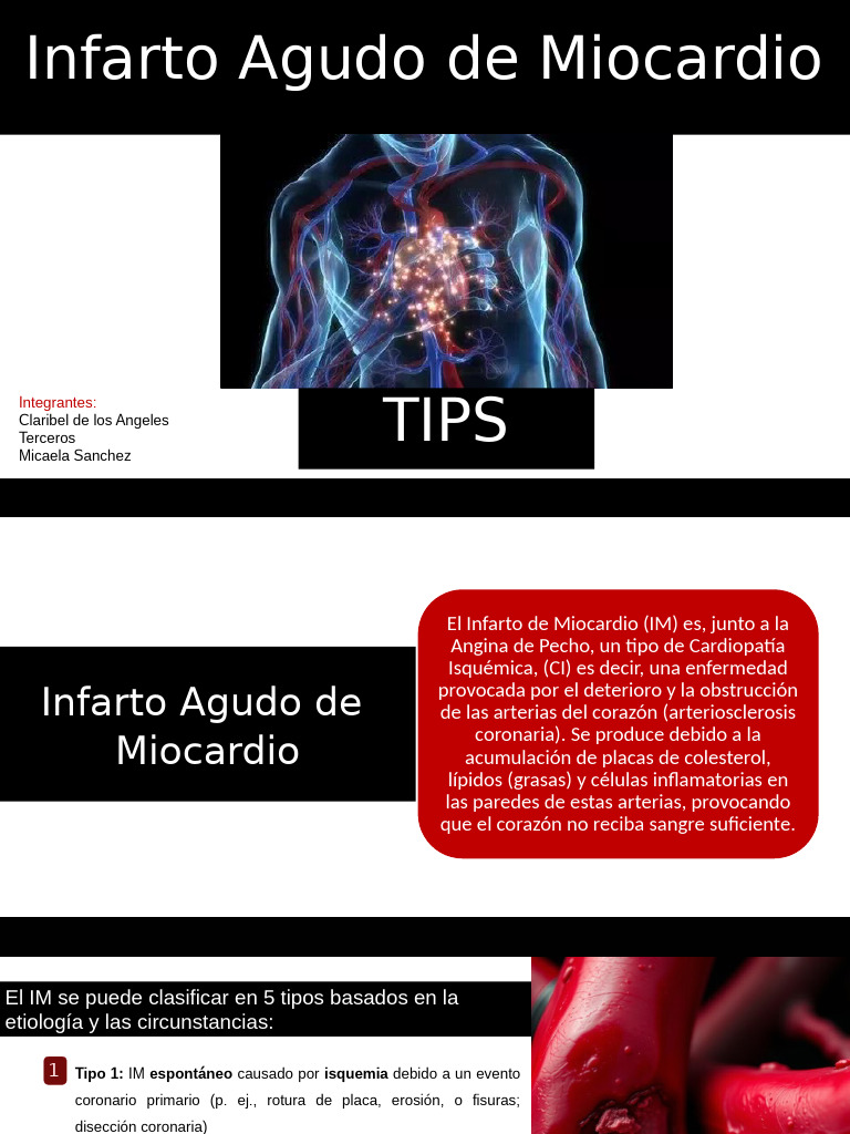 IAM Tips | PDF | Infarto de miocardio | Isquemia