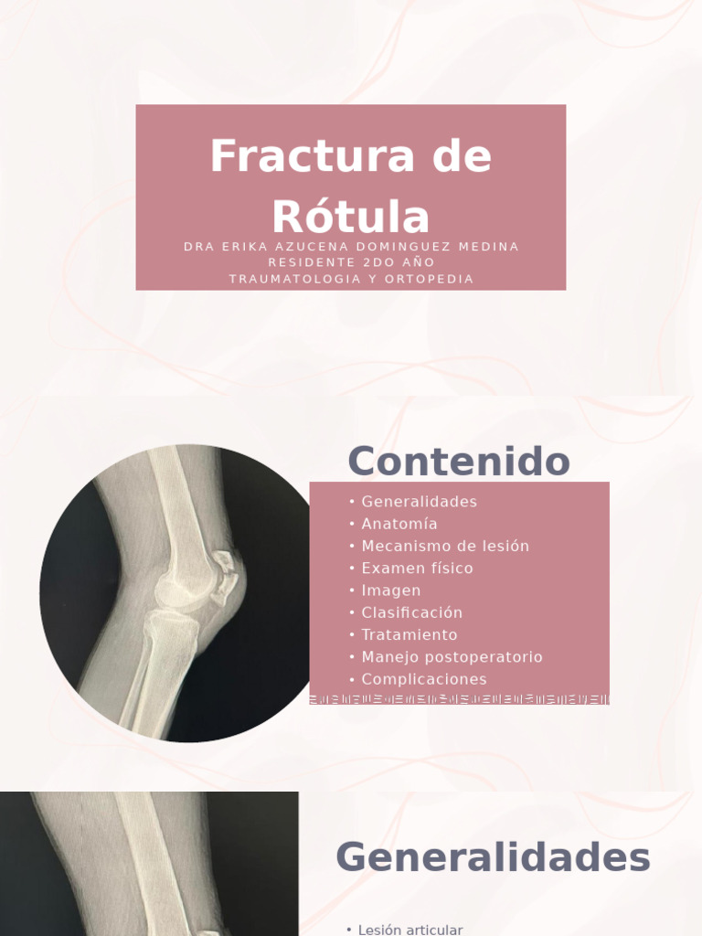 Fractura de Rótula: Diagnóstico y Tratamiento | PDF | Rodilla ...