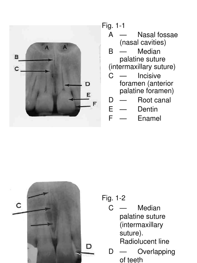 Median palatine suture deals