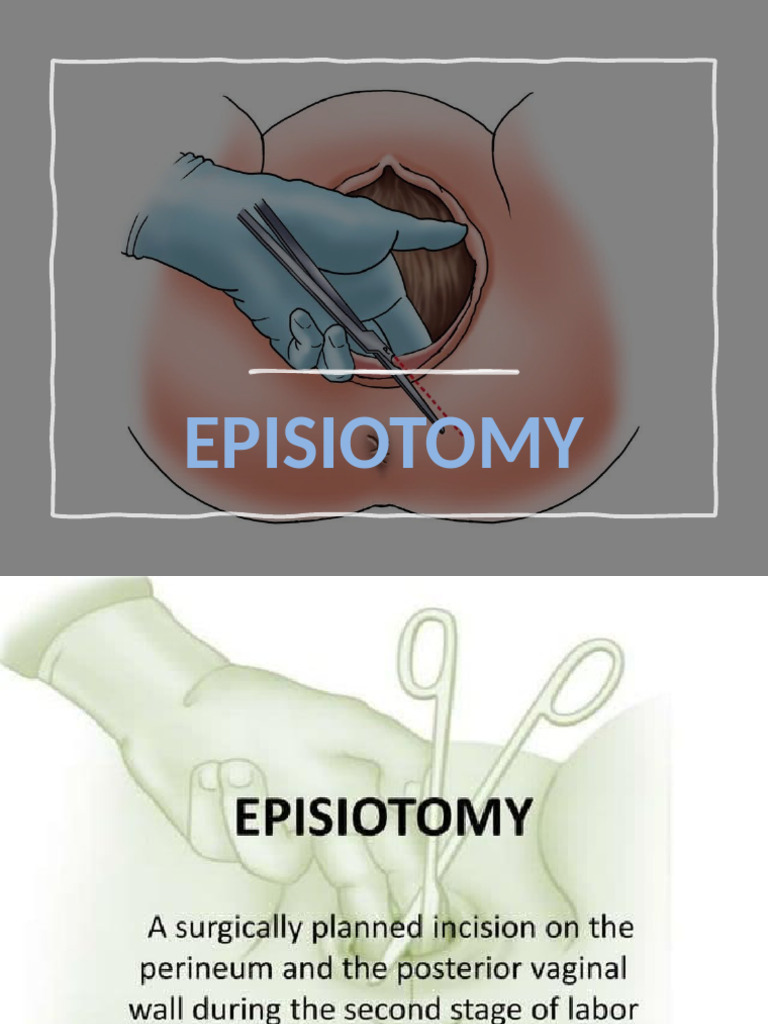 Episiotomy | PDF