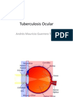 Tuberculosis Ocular