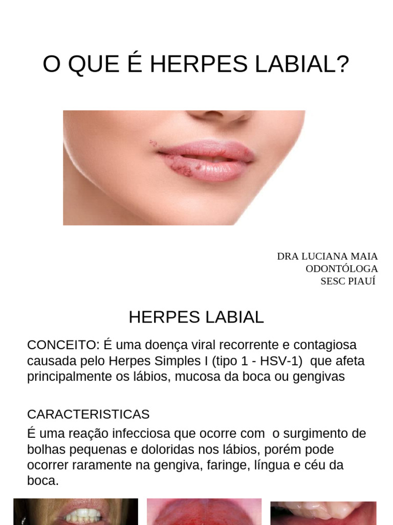 Entendendo o Herpes Labial: Causas e Sintomas | PDF | Especialidades ...