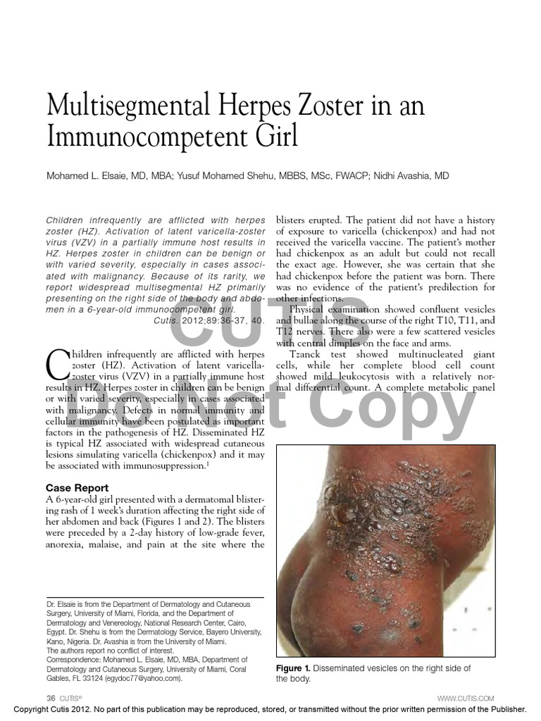 Multisegmental Herpes Zoster in An Immunocompetent Girl: Cutis Do Not ...