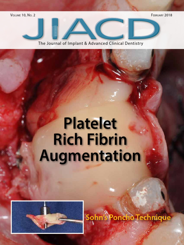 Platelet Rich Fibrin Augmentation | PDF | Dental Implant | Medical ...