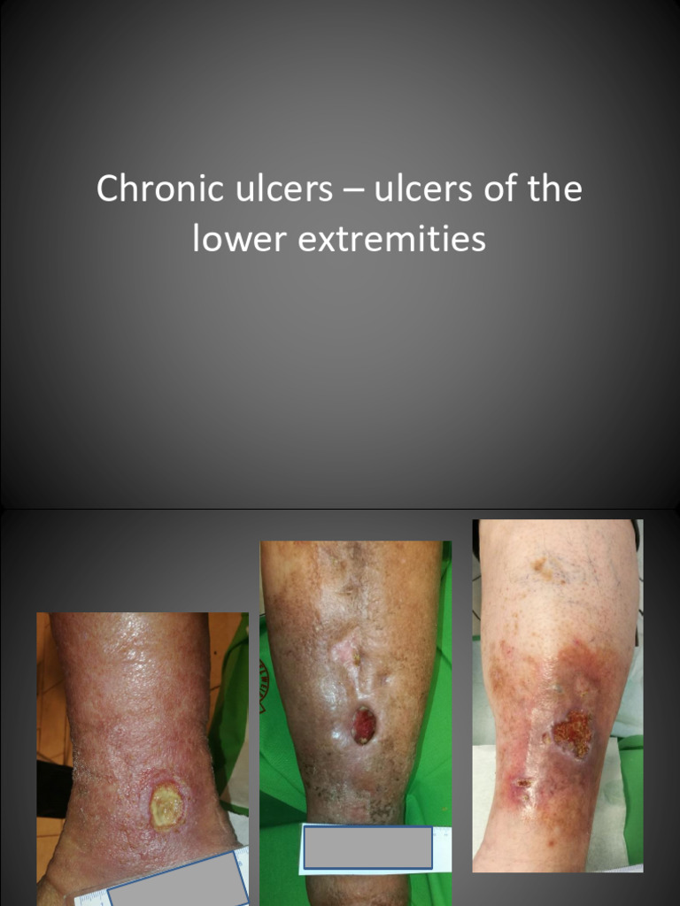 Ulcus Cruris PBL Angol | PDF | Diseases And Disorders | Medical Specialties